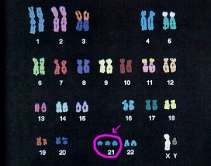 trisomia 21, zespół Downa, down syndrome, przyczyna, chromosomy